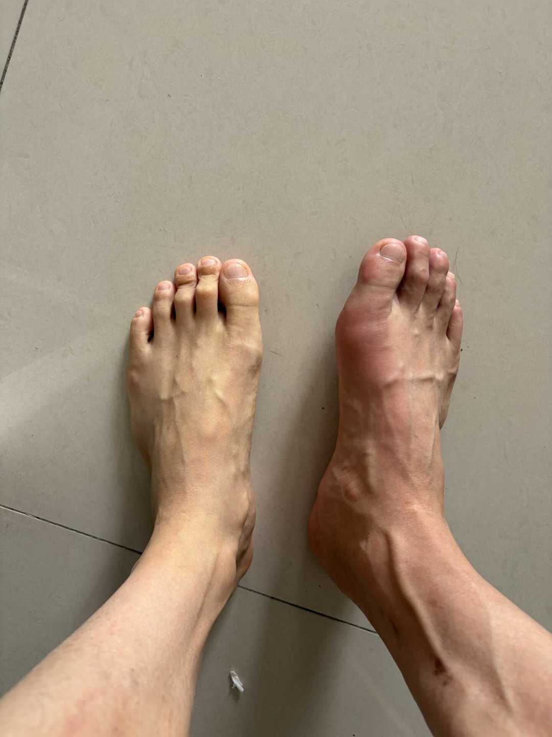 打赢非布司他?这个痛风新药才刚考完