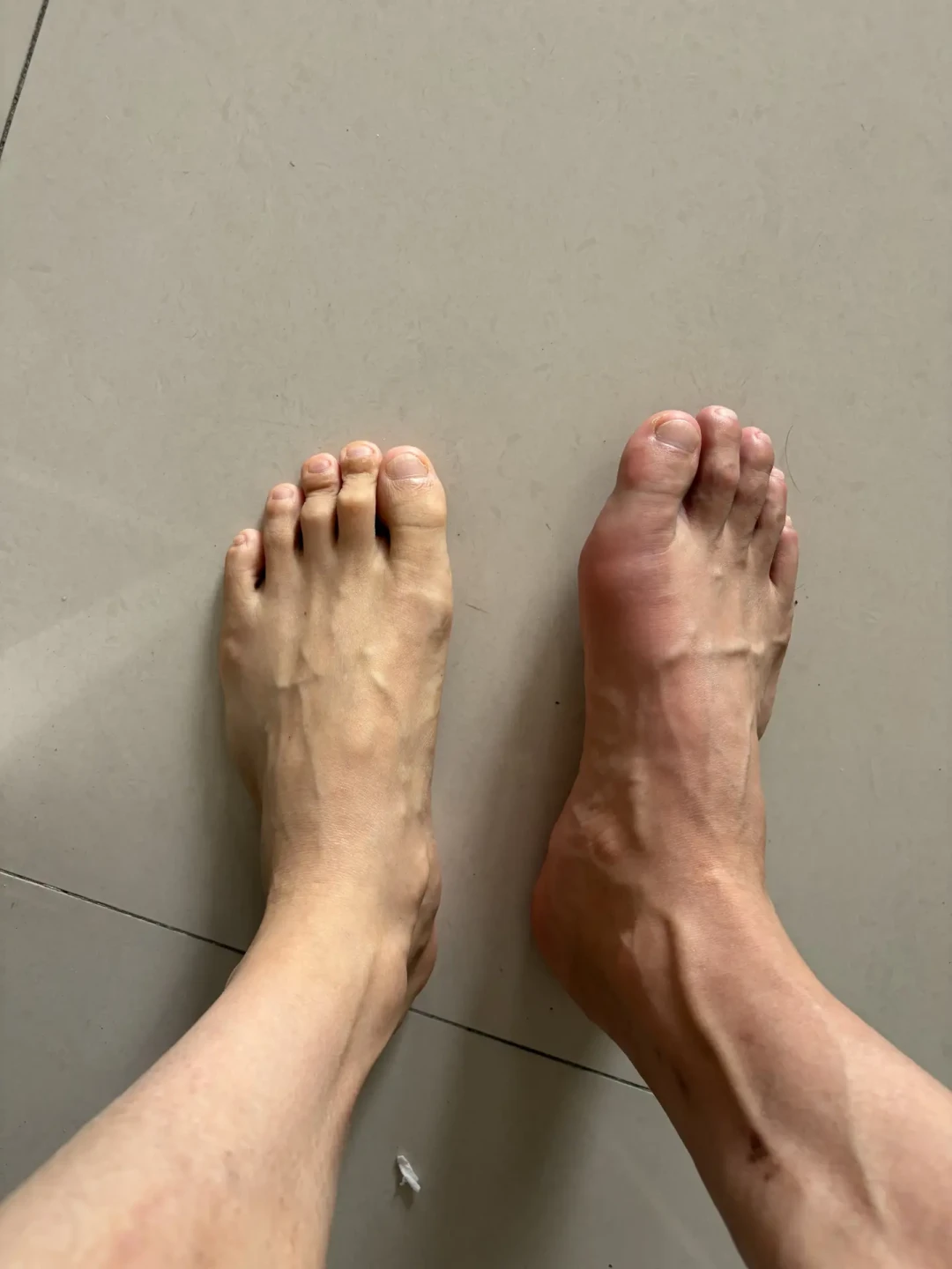 尿酸降不下来？信达痛风新药二期85.7%达标率，但先别停现在吃的药