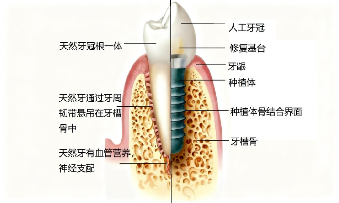 种植牙降到7000块,集采2.0也启动:你的账单可能不止这个数