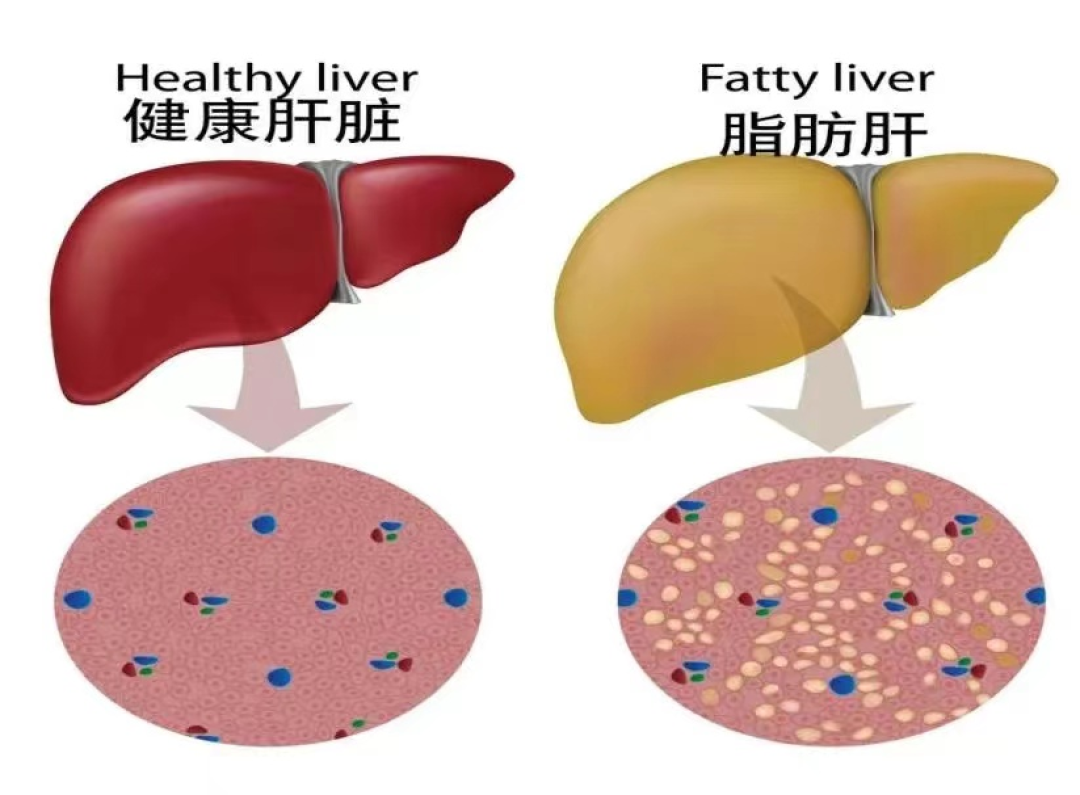 查出脂肪肝,跑步还是撸铁?先把报告看一遍,再排这一周