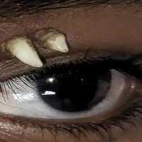 印度少年眼睛上方长出一颗牙：医生称闻所未闻 顺手给拔了