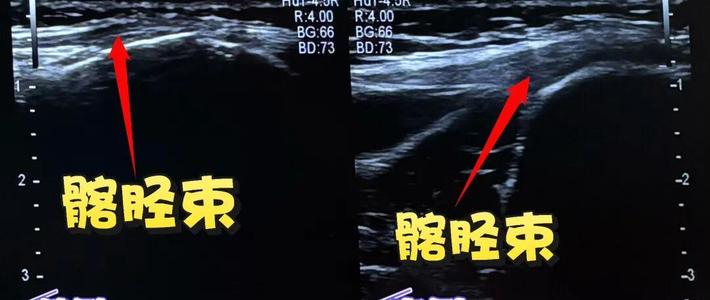 北马明天鸣枪，下周运动医学科会挤满跑者：膝盖疼分三种，“休息两天就好”恰恰是最迷惑的一种