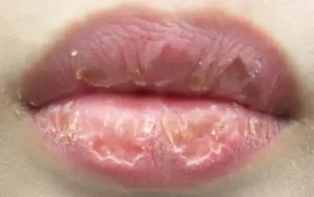 嘴唇怎么涂都脱皮？先别加唇膜：分清