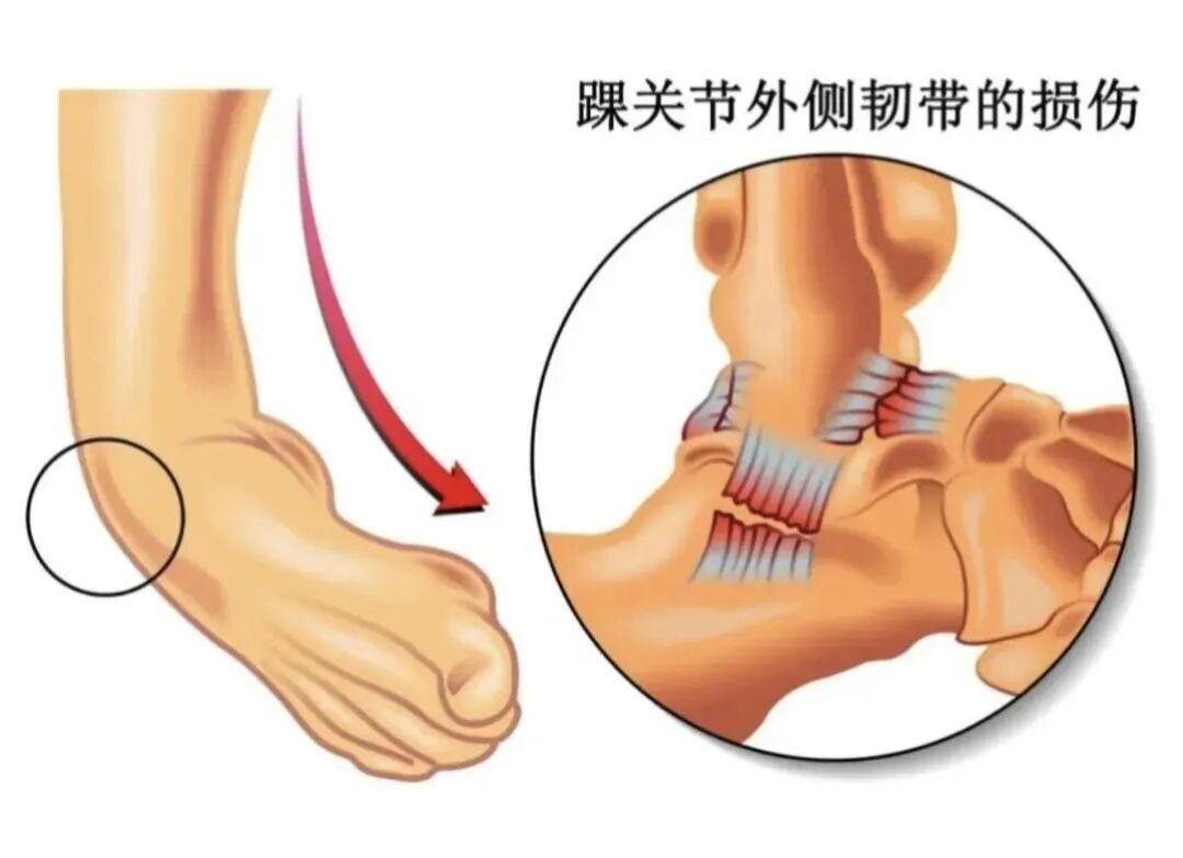 崴过的脚"好了"却总再崴？别怪运气差——韧带长松了，脚踝的定位系统也断了线：先按四条红线排除骨折，再分三步把平衡、力量、变向练回来，回球场前几个月戴绑带式护踝