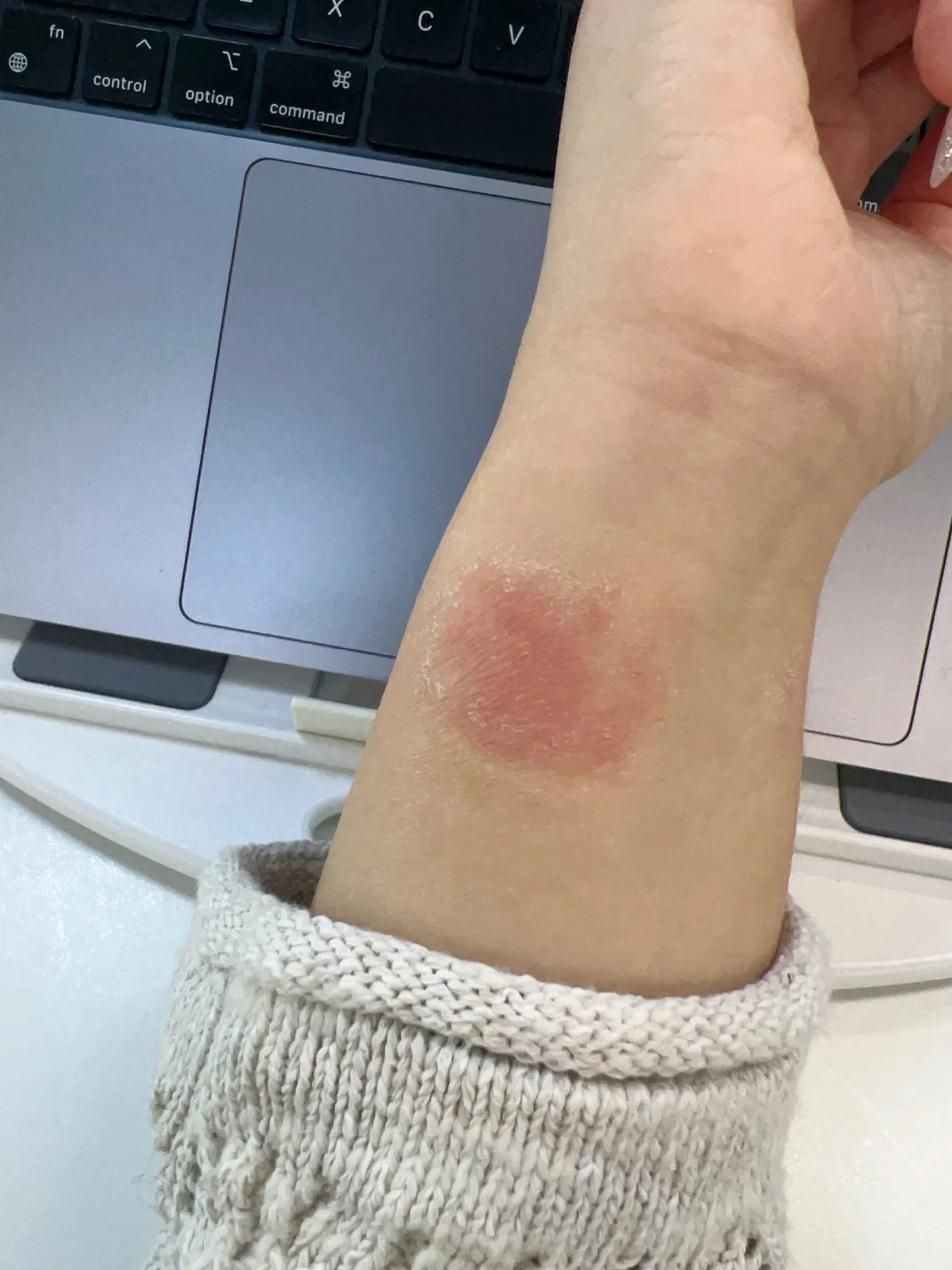 手腕上那圈红痒不是绿光的锅：紧、焐、敏三个字，对号入座