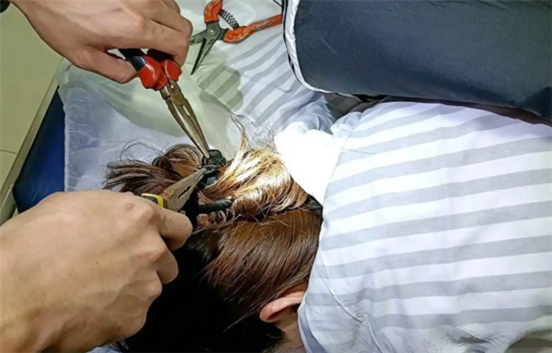 女子出车祸鲨鱼夹插入后脑勺:常见的装饰件有可能害人命