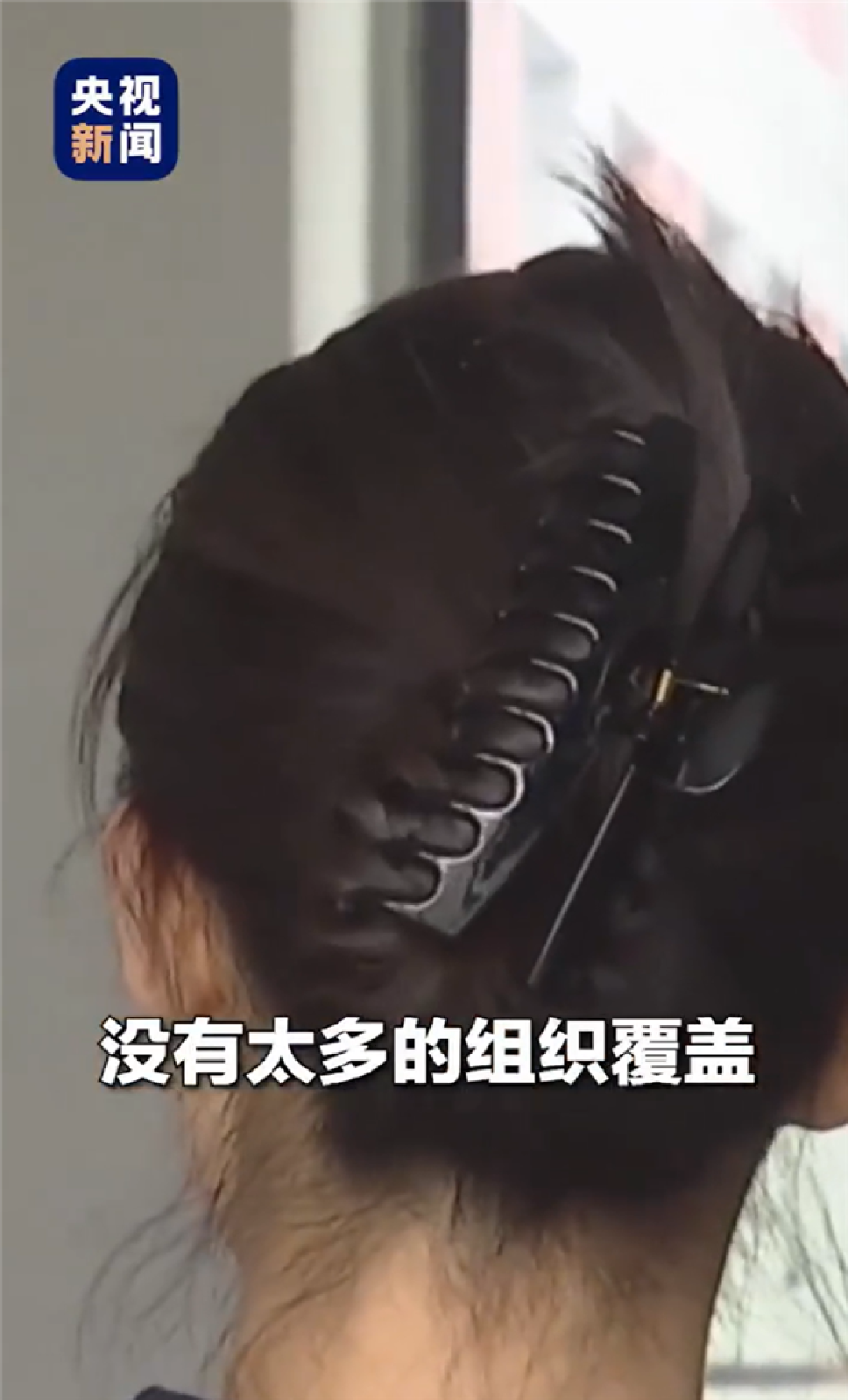 女子出车祸鲨鱼夹插入后脑勺:常见的装饰件有可能害人命
