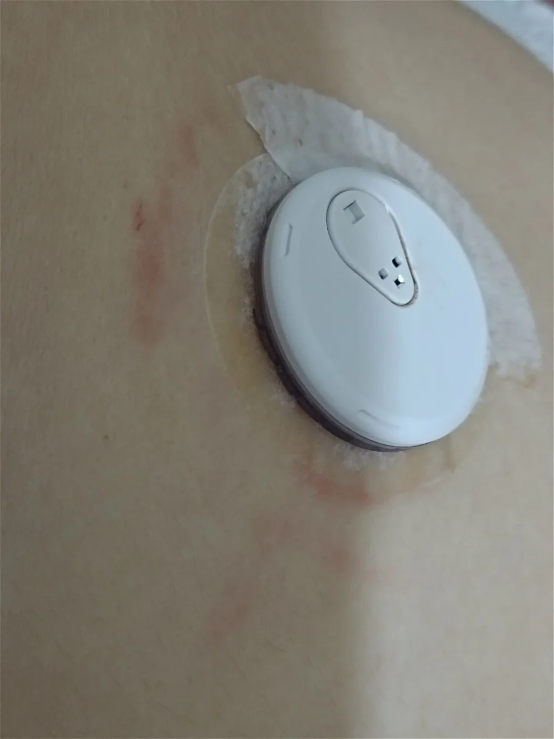 戴三诺爱看先痒了:撕了疼,忍着更疼,痒点多在那圈胶布