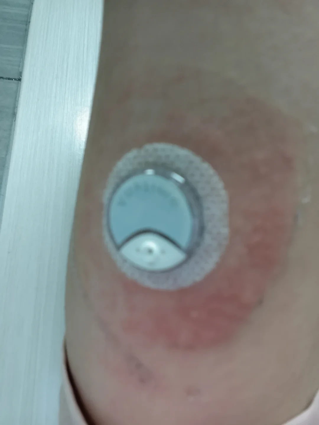 戴三诺爱看先痒了:撕了疼,忍着更疼,痒点多在那圈胶布