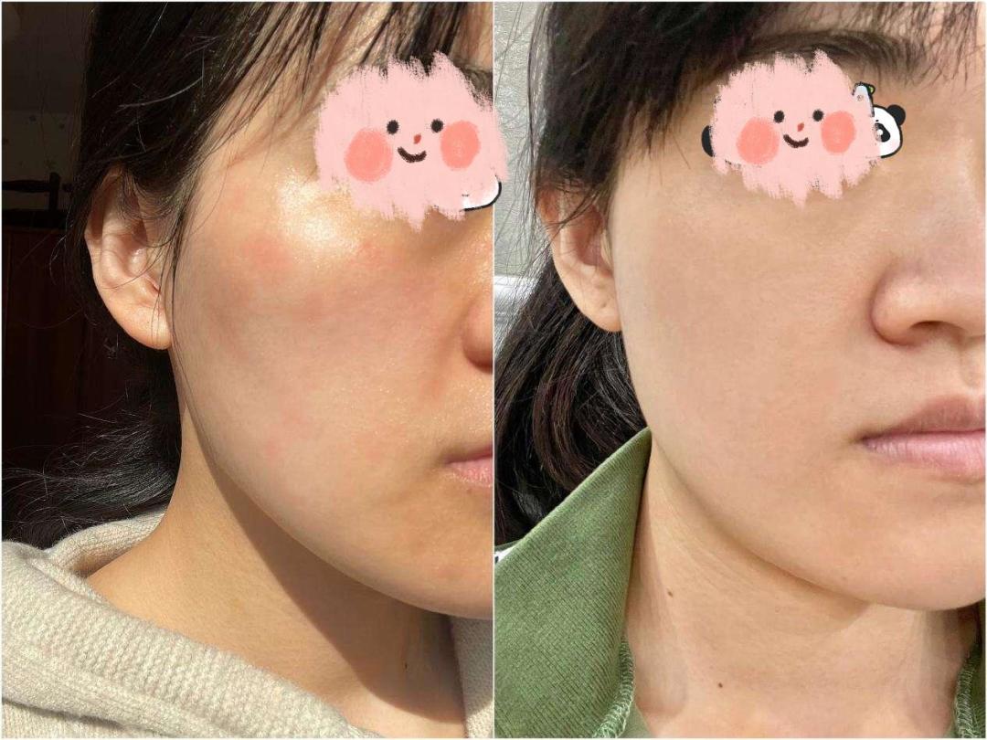 熬夜脸垮别急着上精华:皮肤科医生自用急救法,0成本打底