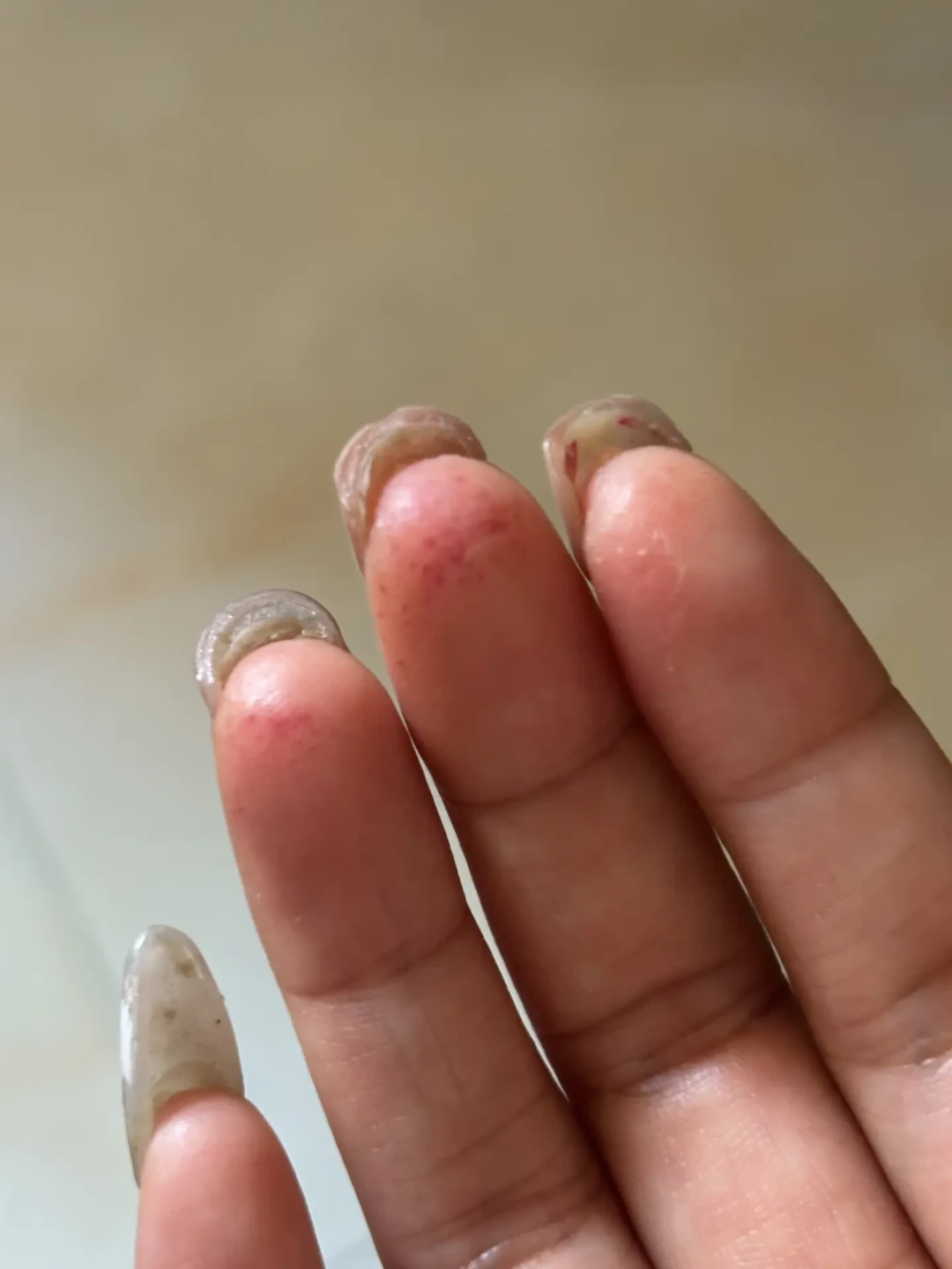 用了几年都没事,突然满手起泡:甲油胶过敏到底怎么回事
