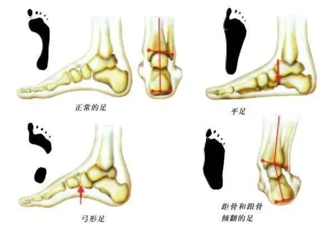 体测提分神话被辟谣!校园顶碳风,别让学生鞋进课堂