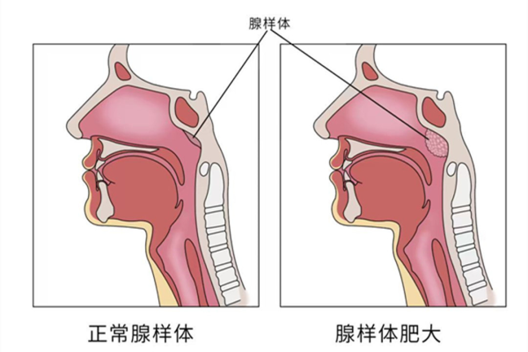 网红“防变丑”口呼吸贴:贴得住嘴,贴不回下巴