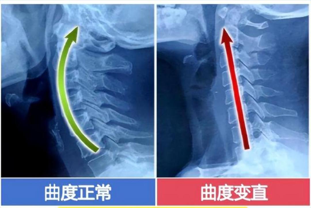 40岁肩颈操只管两小时:低头60度,颈椎扛27公斤