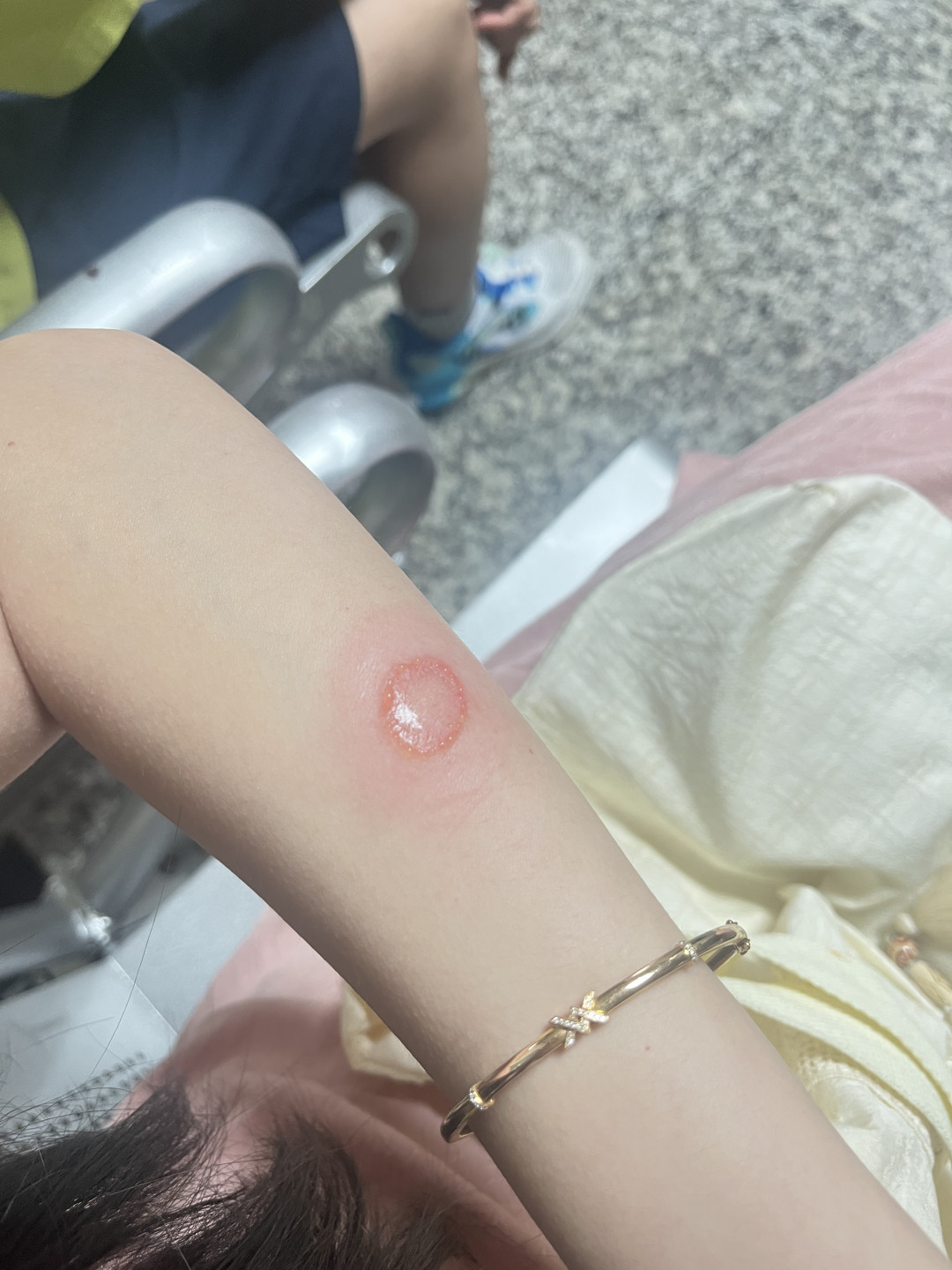 实拍：人被传染后的环形红斑（体癣）
