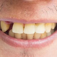 掉牙和寿命有关？60岁后，牙齿剩多少颗才正常？看看你达标了没