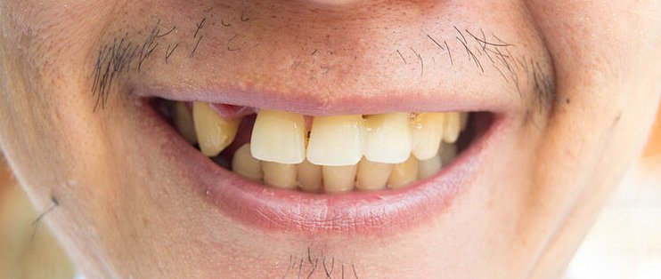 掉牙和寿命有关？60岁后，牙齿剩多少颗才正常？看看你达标了没