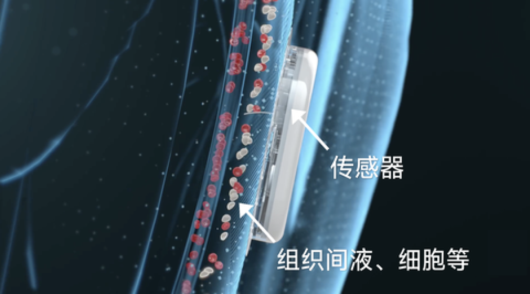 动态血糖仪前7天准后7天不准?先别急着退,读懂组织液滞后再说