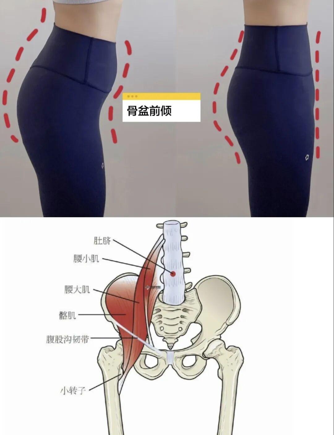骨盆前倾与骨盆后倾的解剖示意图