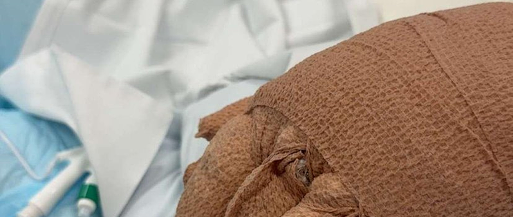 扫地机器人炸在家里，男子烧伤：8周、3次手术后他出院了，爆炸原因还在调查