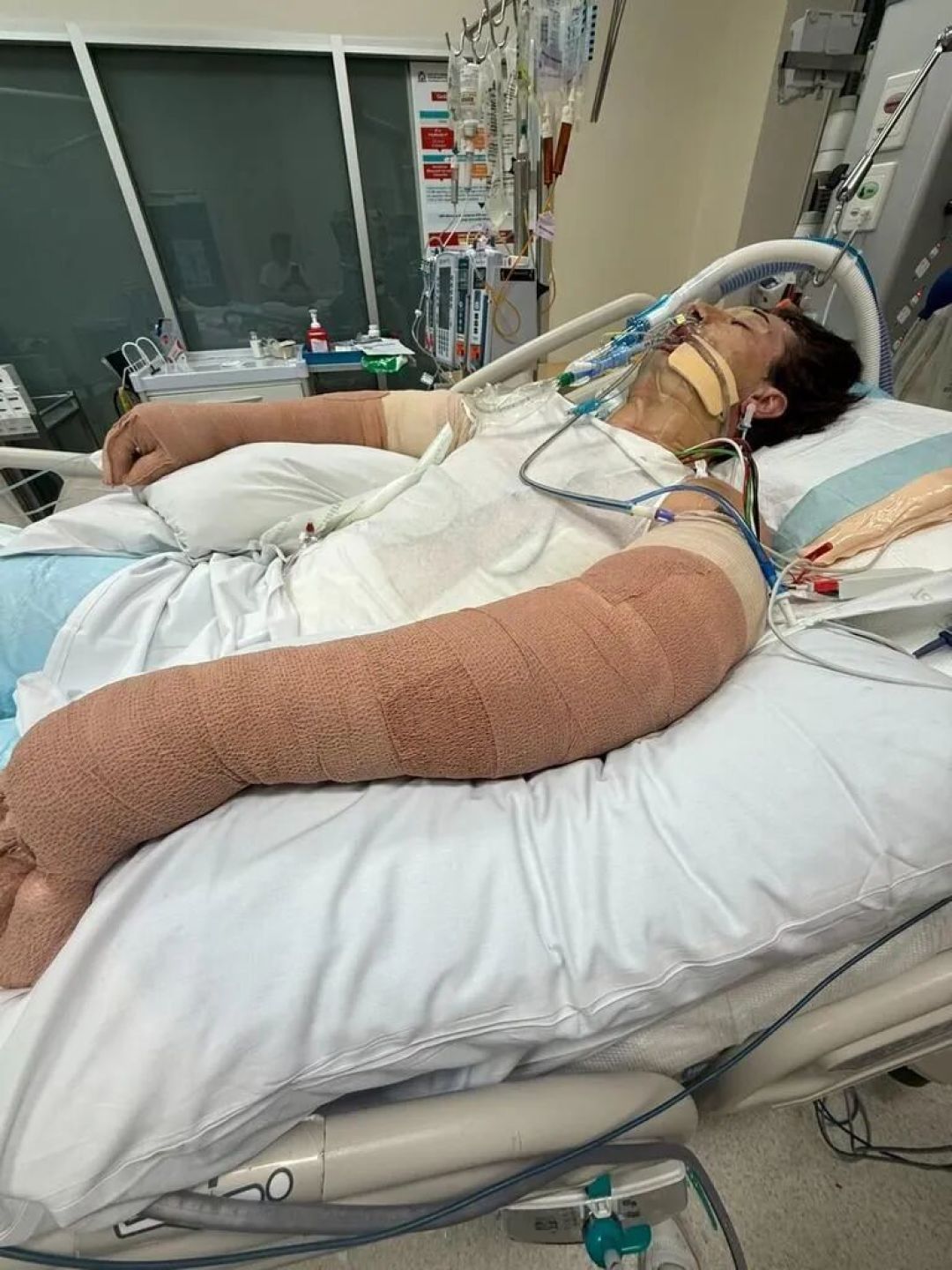 扫地机器人炸在家里,男子烧伤:8周、3次手术后他出院了,爆炸原因还在调查