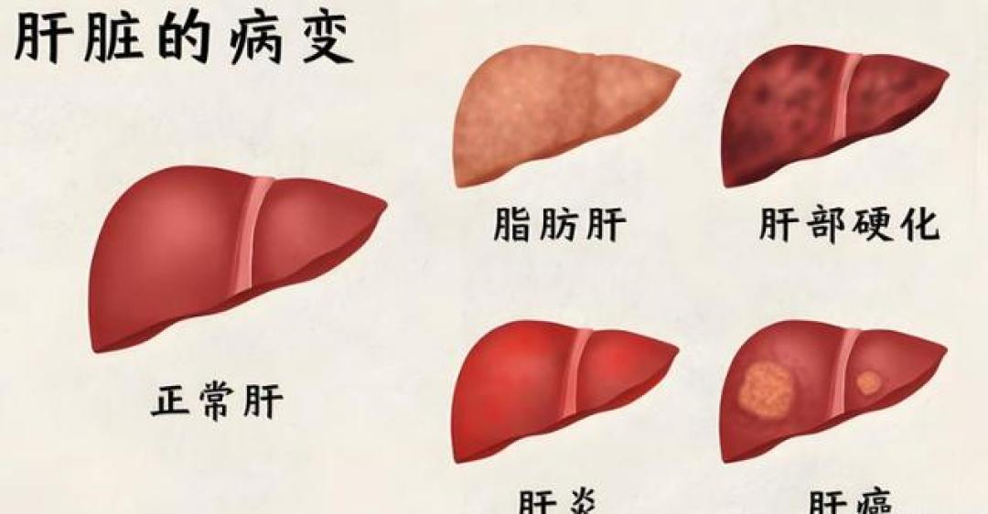40岁脂肪肝老铁练仨月没掉秤?肝受益不看体重看运动量