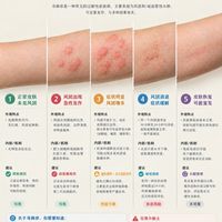 荨麻疹的一生