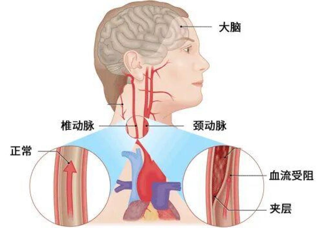 35岁男子筋膜枪打脖子打出脑梗：这3个地方别再打