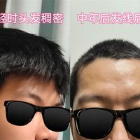 发际线退到M字，中年脱发自救，我开始往头皮上滴一种凉凉的水