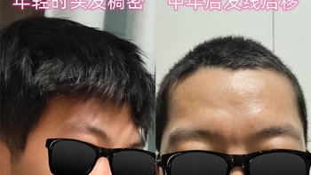 发际线退到M字，中年脱发自救，我开始往头皮上滴一种凉凉的水