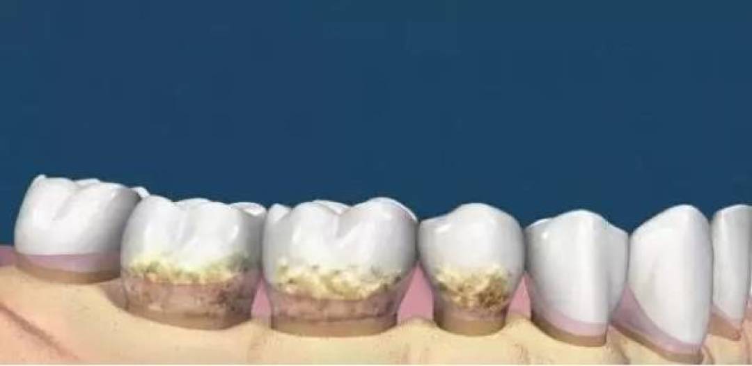 双11别按帖子数选口腔益生菌：同一分钟刷屏的同品牌