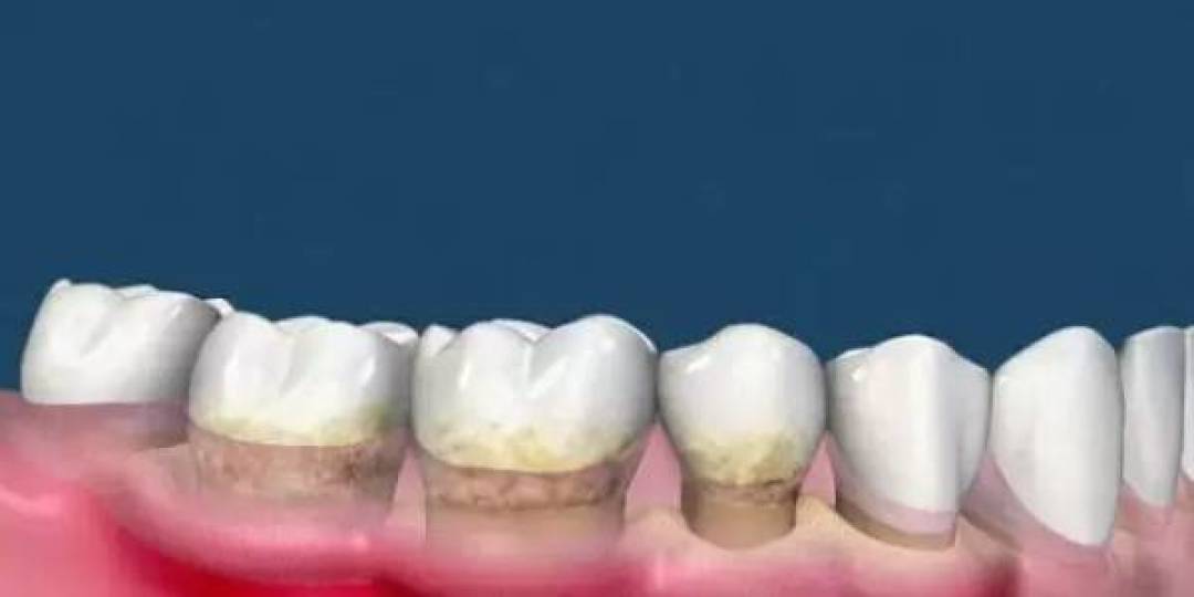 双11别按帖子数选口腔益生菌：同一分钟刷屏的同品牌