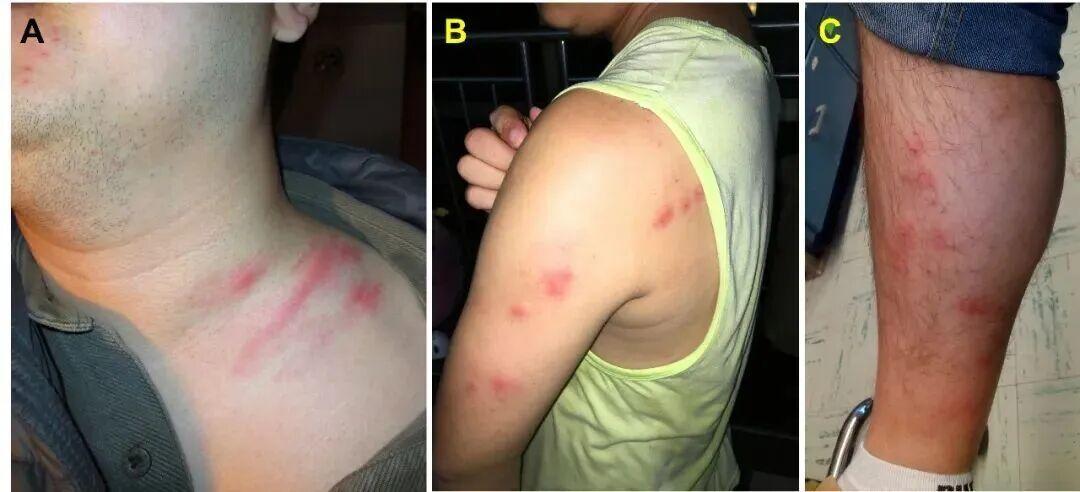 订酒店先查“床虱地图”?先看懂红点的“证据含金量”,再学会进房3分钟自查