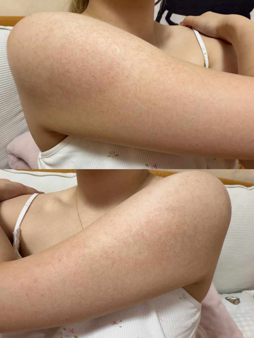 胳膊上的小疙瘩越搓越糟?鸡皮肤不是没洗干净,这3件事才真有用