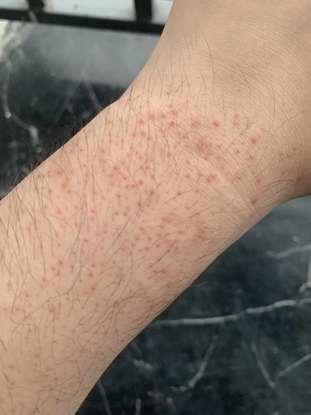 胳膊上的小疙瘩越搓越糟?鸡皮肤不是没洗干净,这3件事才真有用