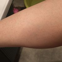 胳膊上的小疙瘩越搓越糟？鸡皮肤不是没洗干净，这3件事才真有用