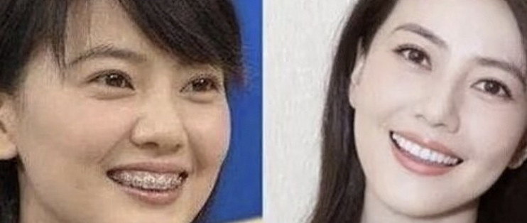 高圆圆为整牙息影一年，陈冠希牙黄照样咧嘴笑，护牙要做好这些