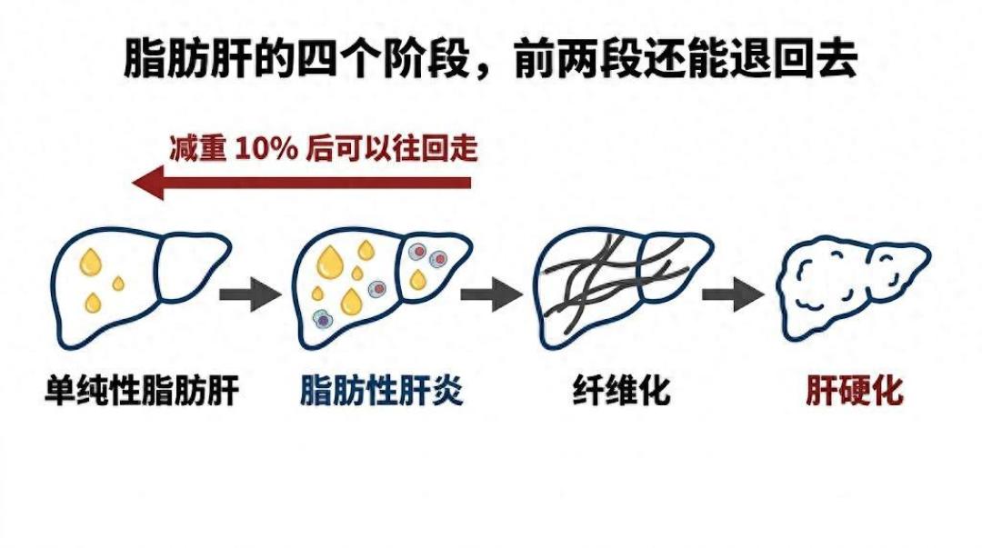 40岁查出脂肪肝，先别戒晚饭：减重10%九成肝炎消退