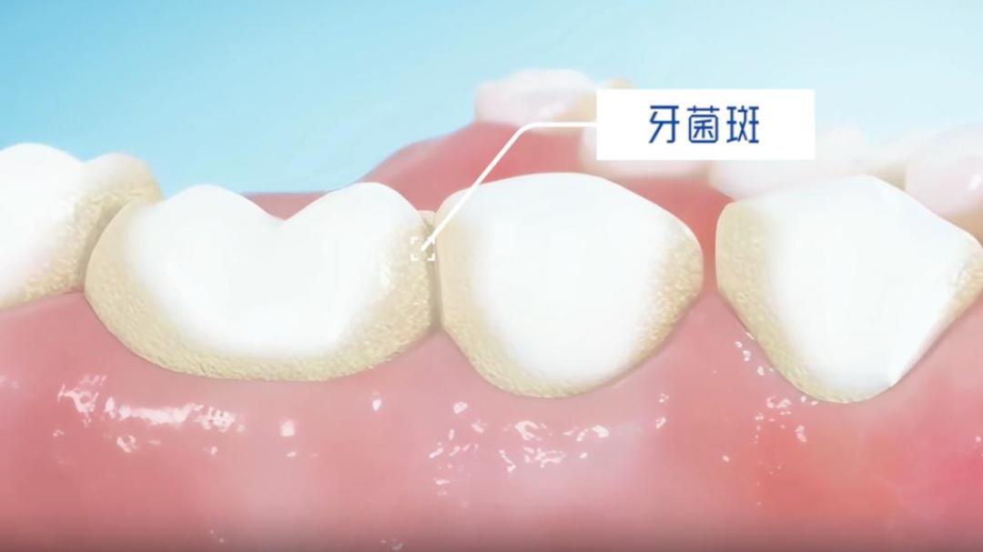 刷牙总出血,别急着换牙膏