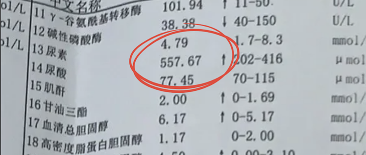 高尿酸痛风别光忌口了！学会吃够这3样，才能真的降