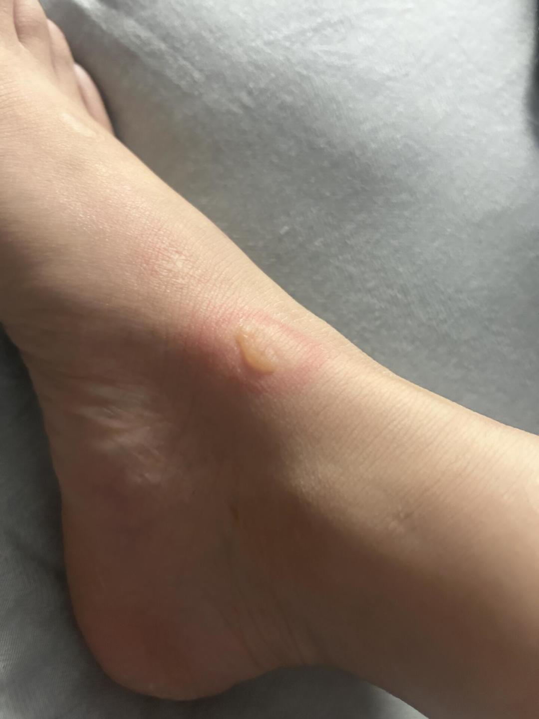 明明试了“不烫”,八旬婆婆却住进了医院:热水袋最怕的不是开水,是你不觉得烫