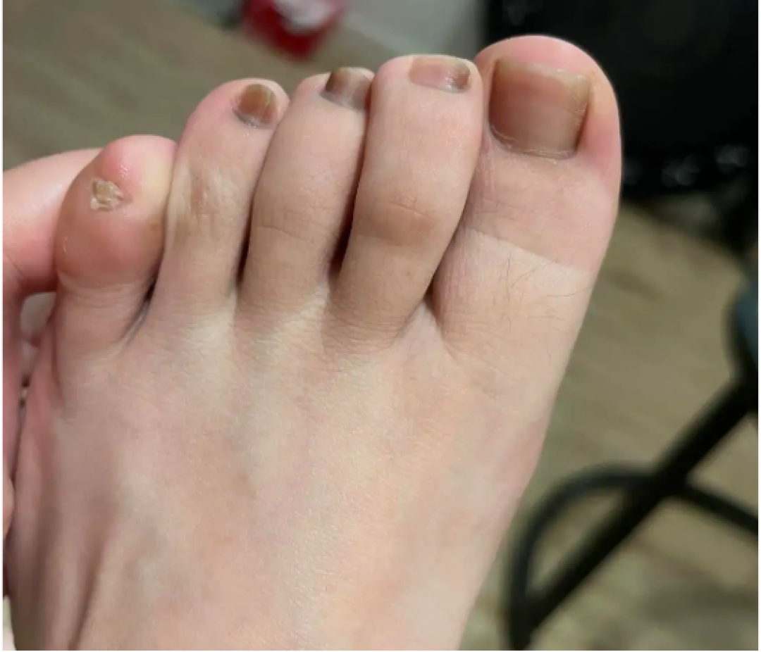跑完步脚趾甲黑了？先别急着领