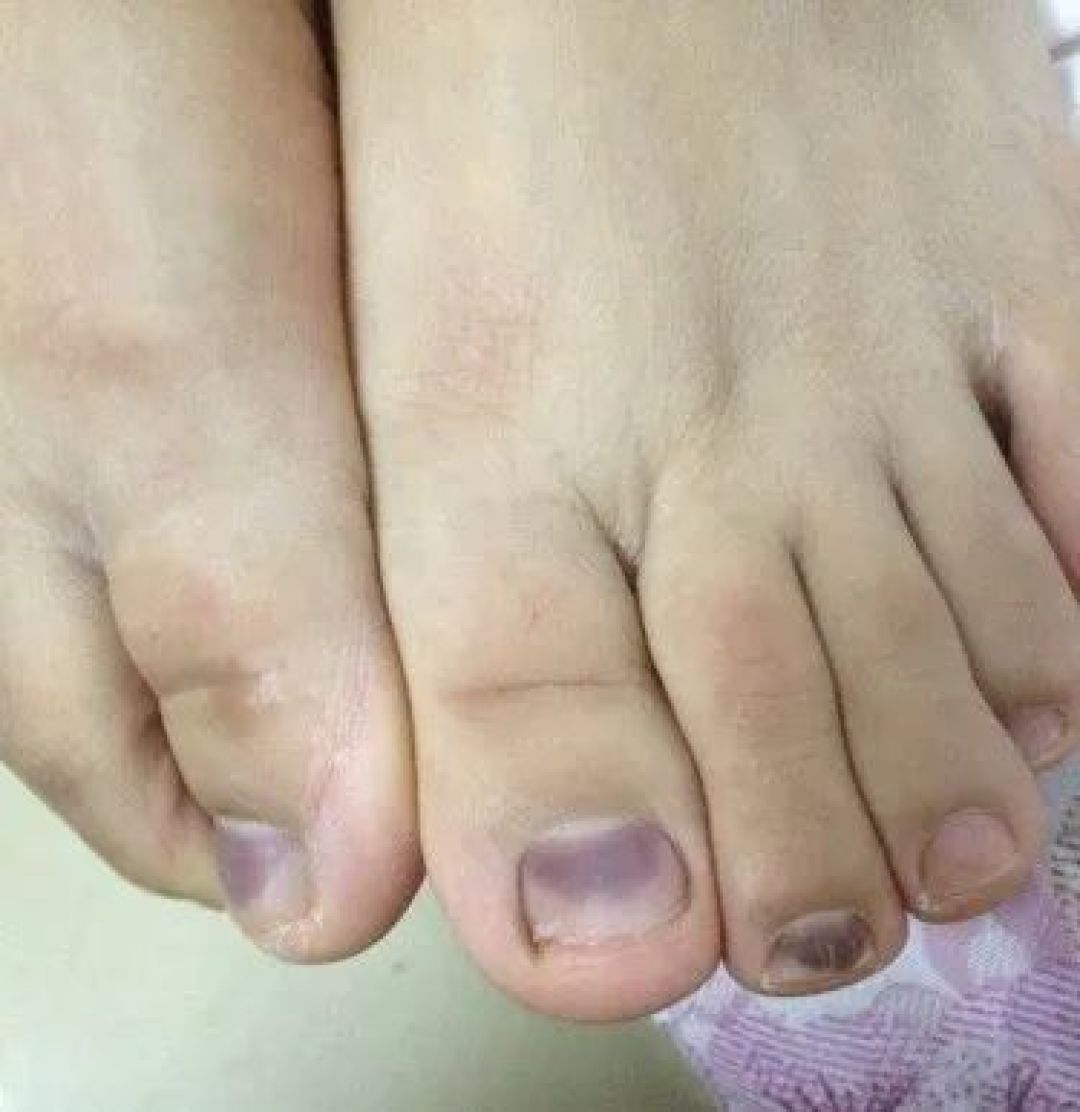 跑完步脚趾甲黑了？先别急着领
