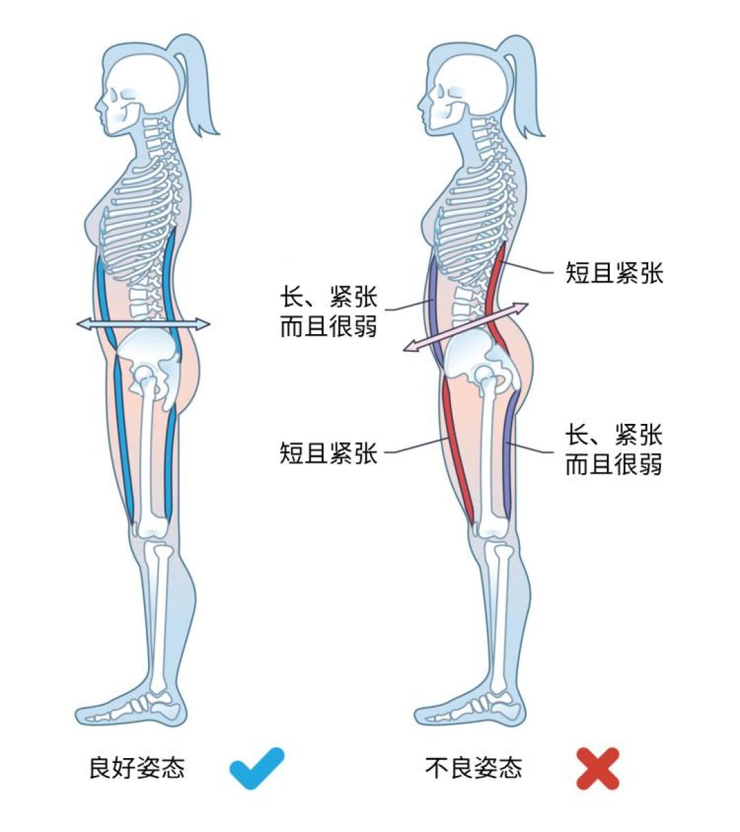 腰后塞得进一个拳头,不等于骨盆前倾:先分清筛查和诊断