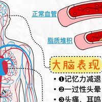 为什么有人说话突然含糊、手脚抬不起来，自己却还硬扛着说没事？