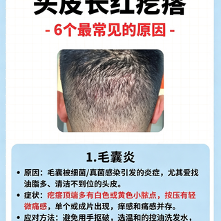 头皮反复长红疙瘩别乱抠!6个元凶对照自查,越抠越容易留疤