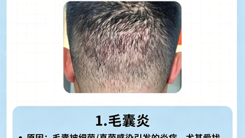 头皮反复长红疙瘩别乱抠！6个元凶对照自查，越抠越容易留疤