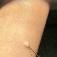 学校组织体检筛查，家长怎么确认操作符合“一人一针”