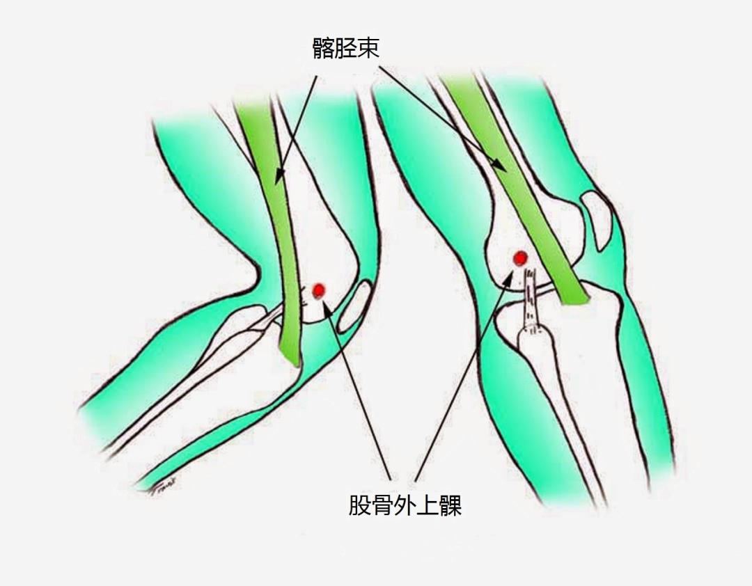 跑到三四公里膝盖外侧就针扎、下楼梯更疼:别急着滚泡沫轴,病根在屁股
