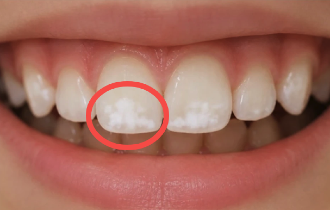孩子不爱刷牙，牙齿都“脱矿”了！这时候还能补救吗？